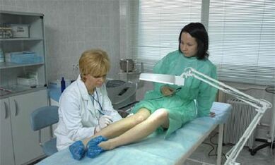 kaip gydyti kojų venų varikozes