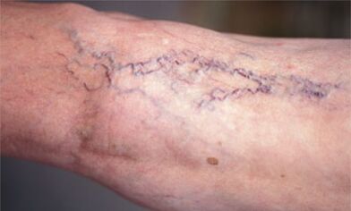 kojų venų varikozės gydymo metodai