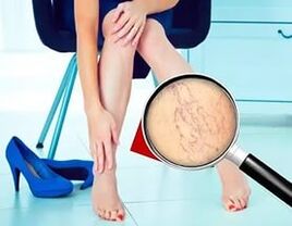 Simptomai priklauso nuo venų varikozės pobūdžio ir stadijos