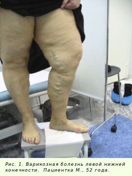 Venų varikozė turi būti gydoma norint sustabdyti procesą