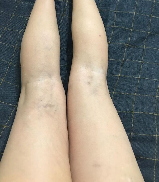 varikozinių venų apraiškos ant kojų